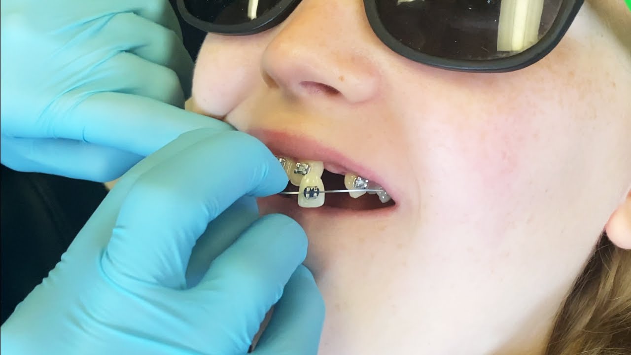 NEW TOOTH NEW SMILE | Amazing Transformation from Dr. Moses