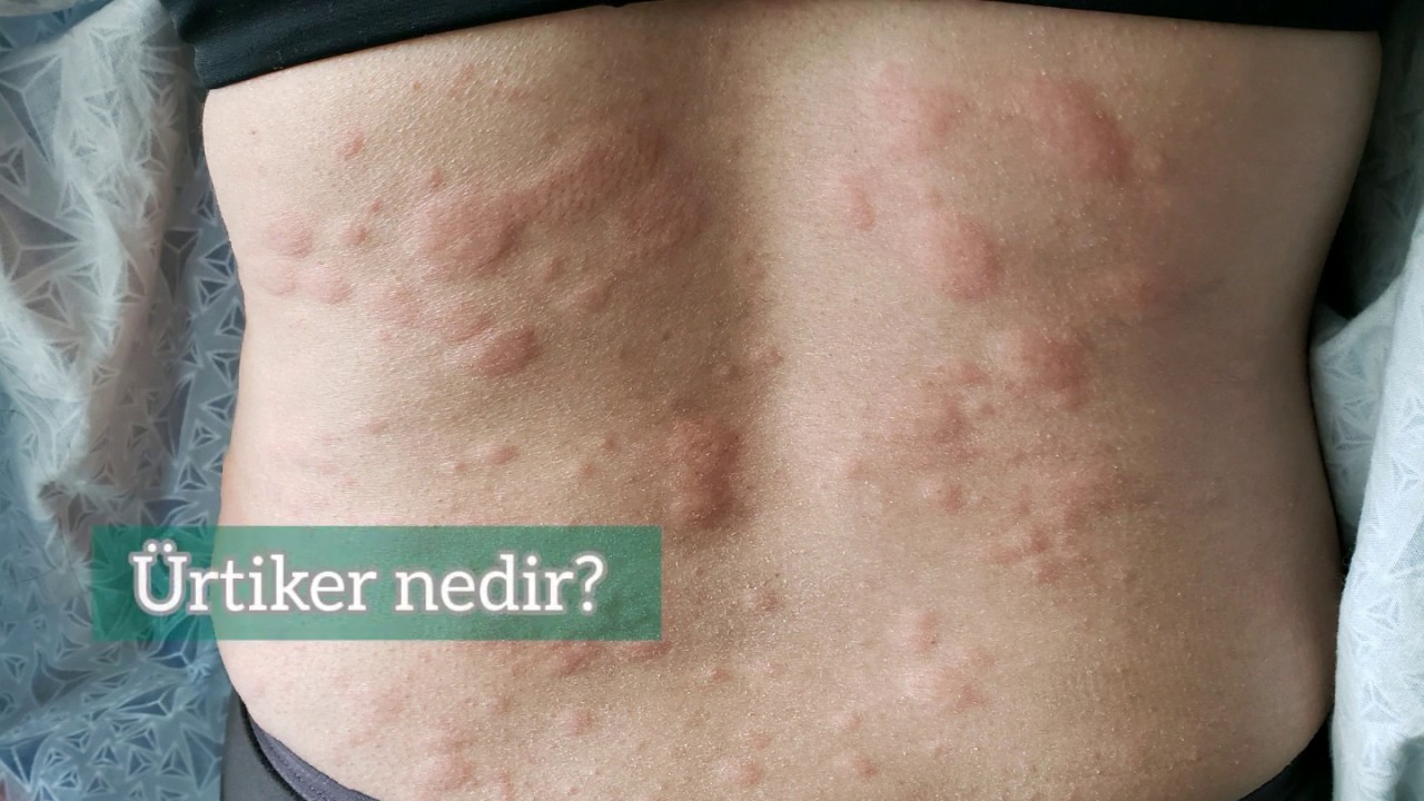 &Uuml;rtiker (Kurdeşen) nedir?