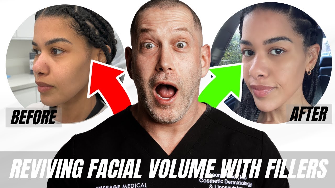 Restoring Lost Facial Volume after HUGE Weight Loss | Dr. Jason Emer