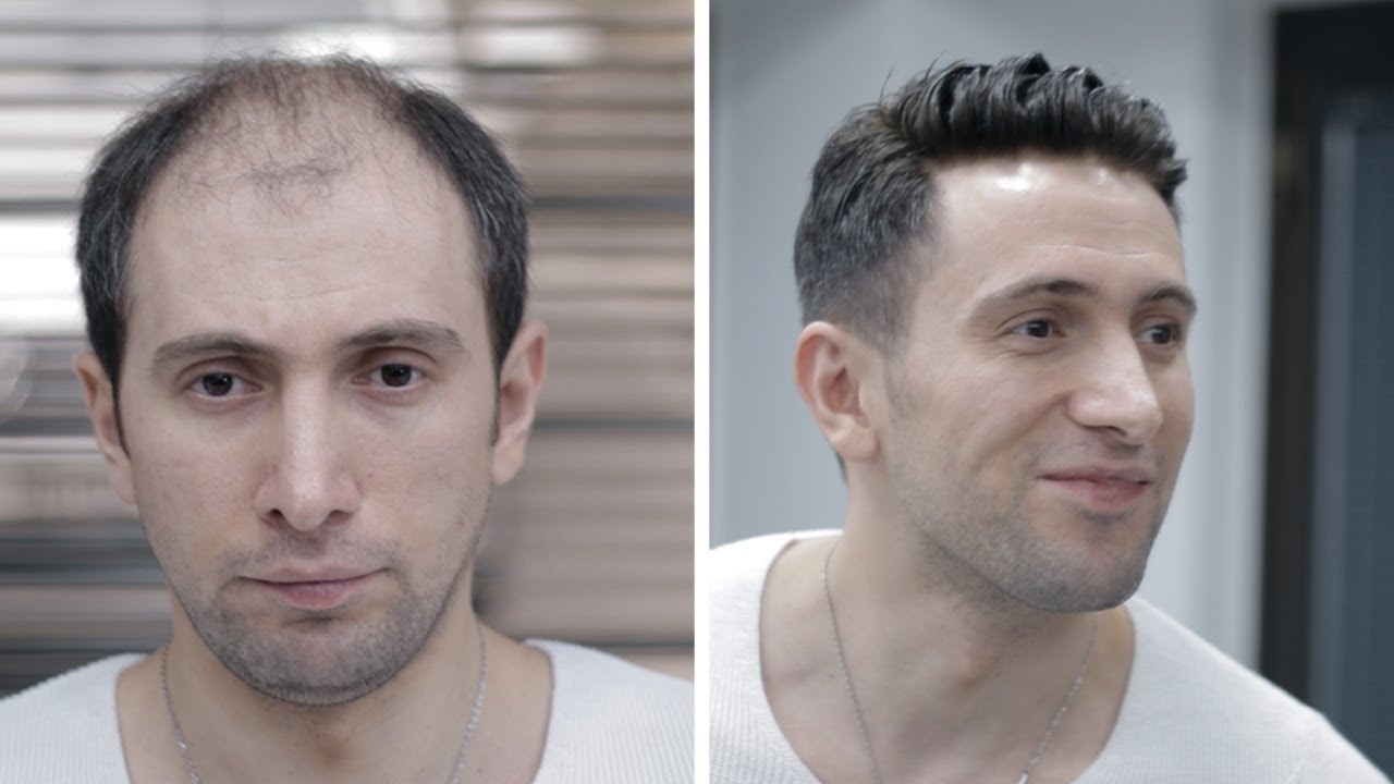 PROTEZ SAÇ UYGULAMASI - Yüzünüzdeki mutuluk bizi mutlu ediyor:) - Hair Replacement