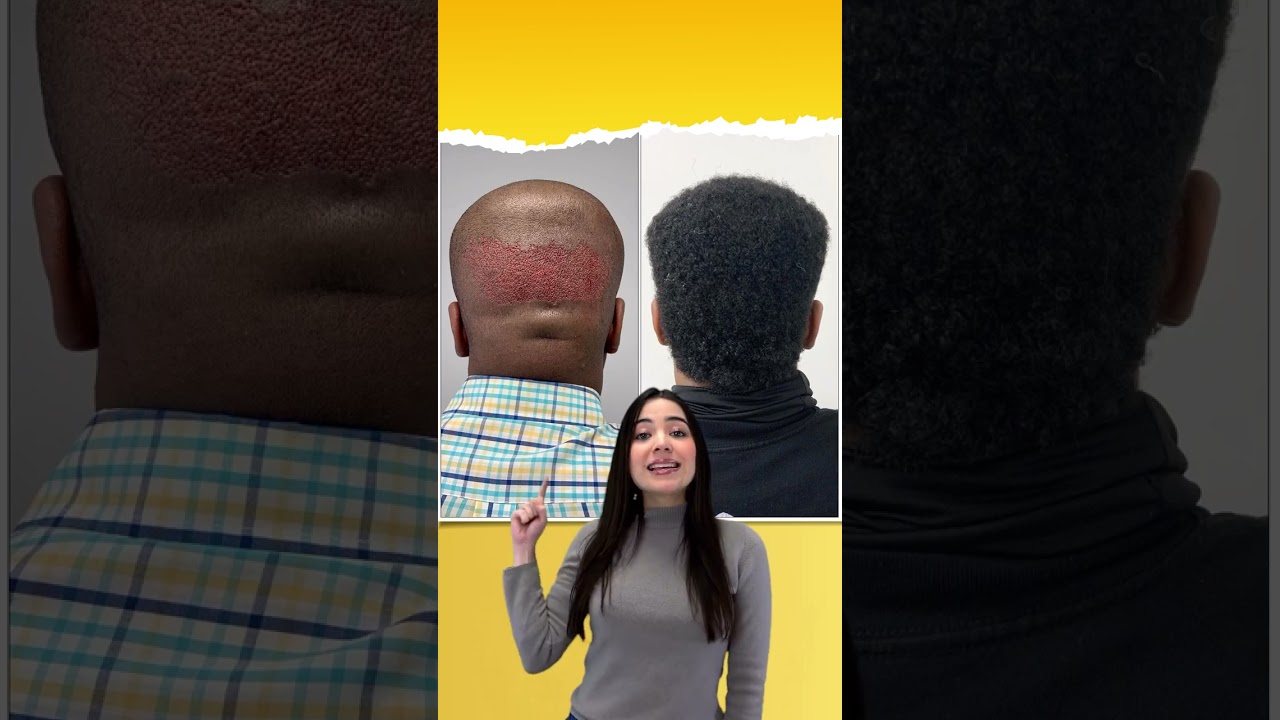 Comparativa antes y después del trasplante capilar. 2.500 fólicos 🙌🏻 | Care4Hair