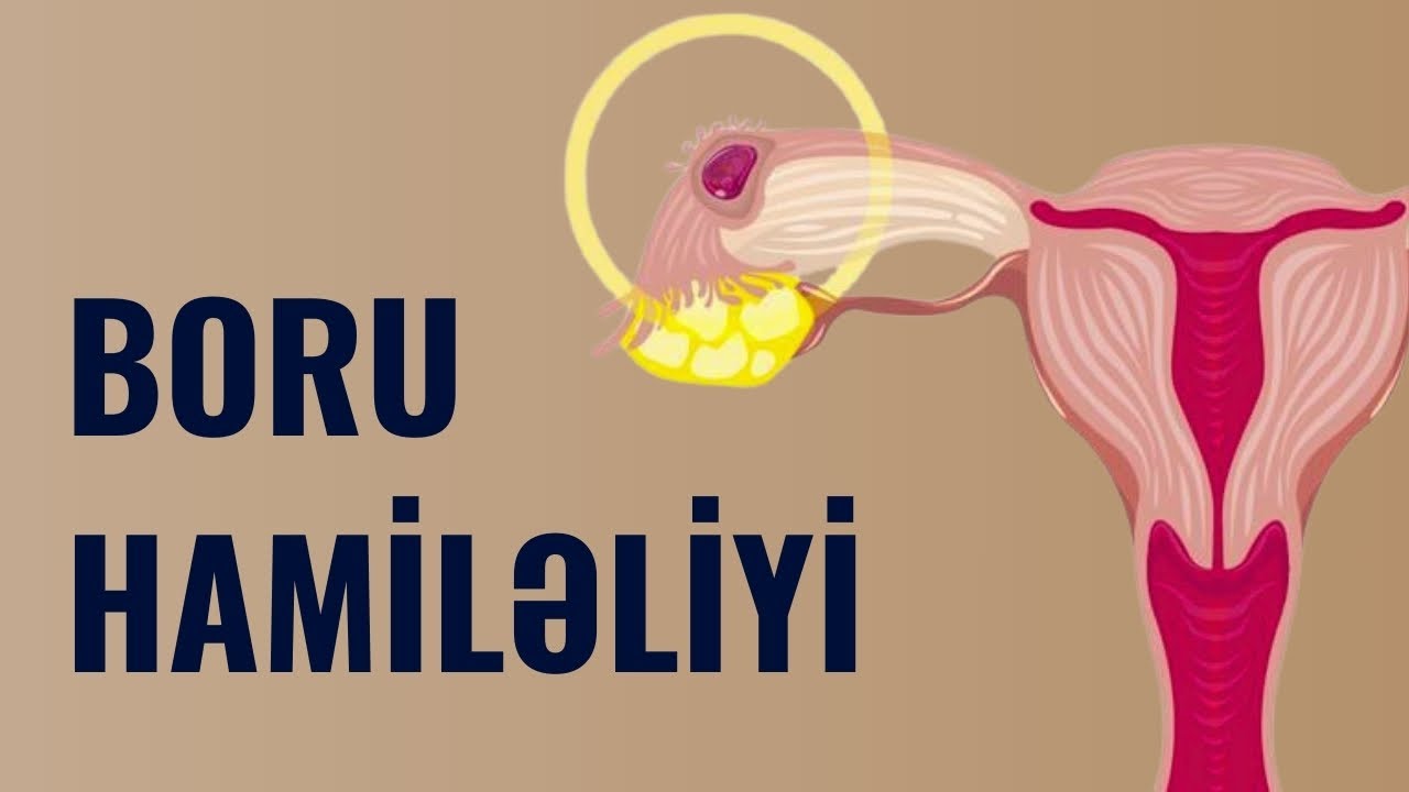 Qadının &Ouml;l&uuml;m&uuml;nə Səbəb olur! - BORU HAMİLƏLİYİ | Ginekoloq V&uuml;salə Əzizova