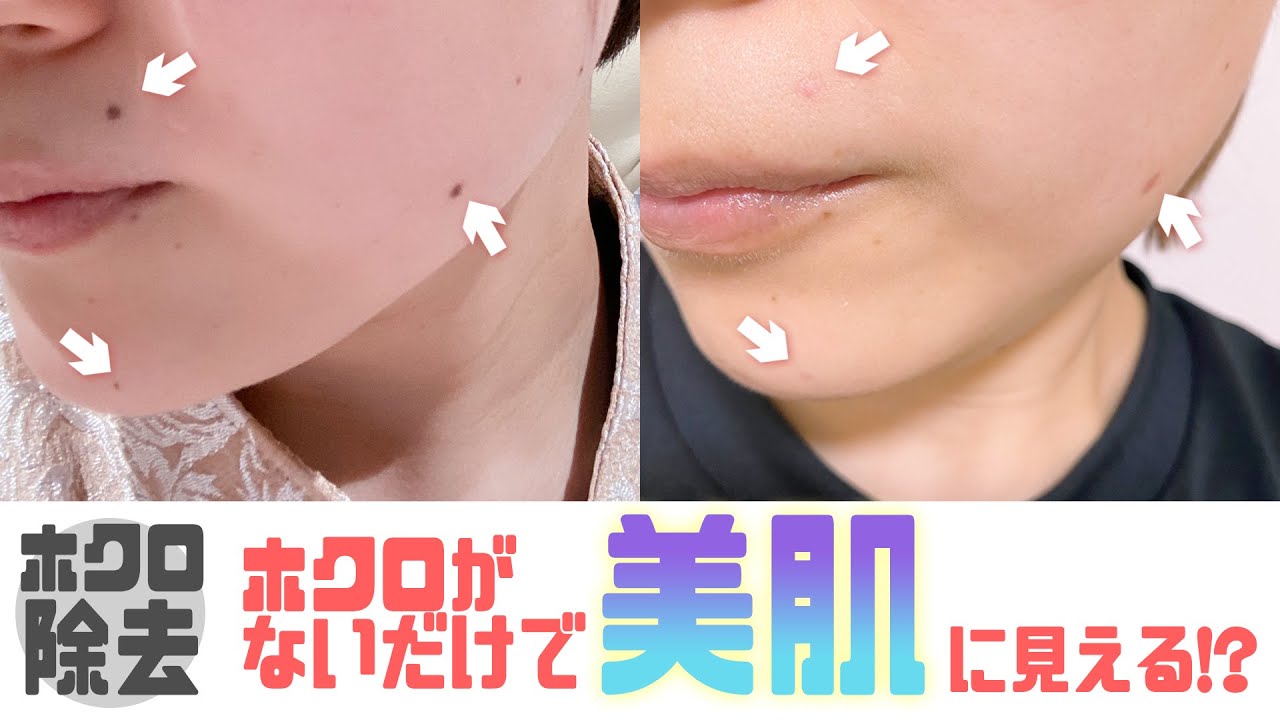 【ほくろ除去】 たった15分で取れる⁈ 4ヶ月までの経過写真&施術映像&解説編!!
