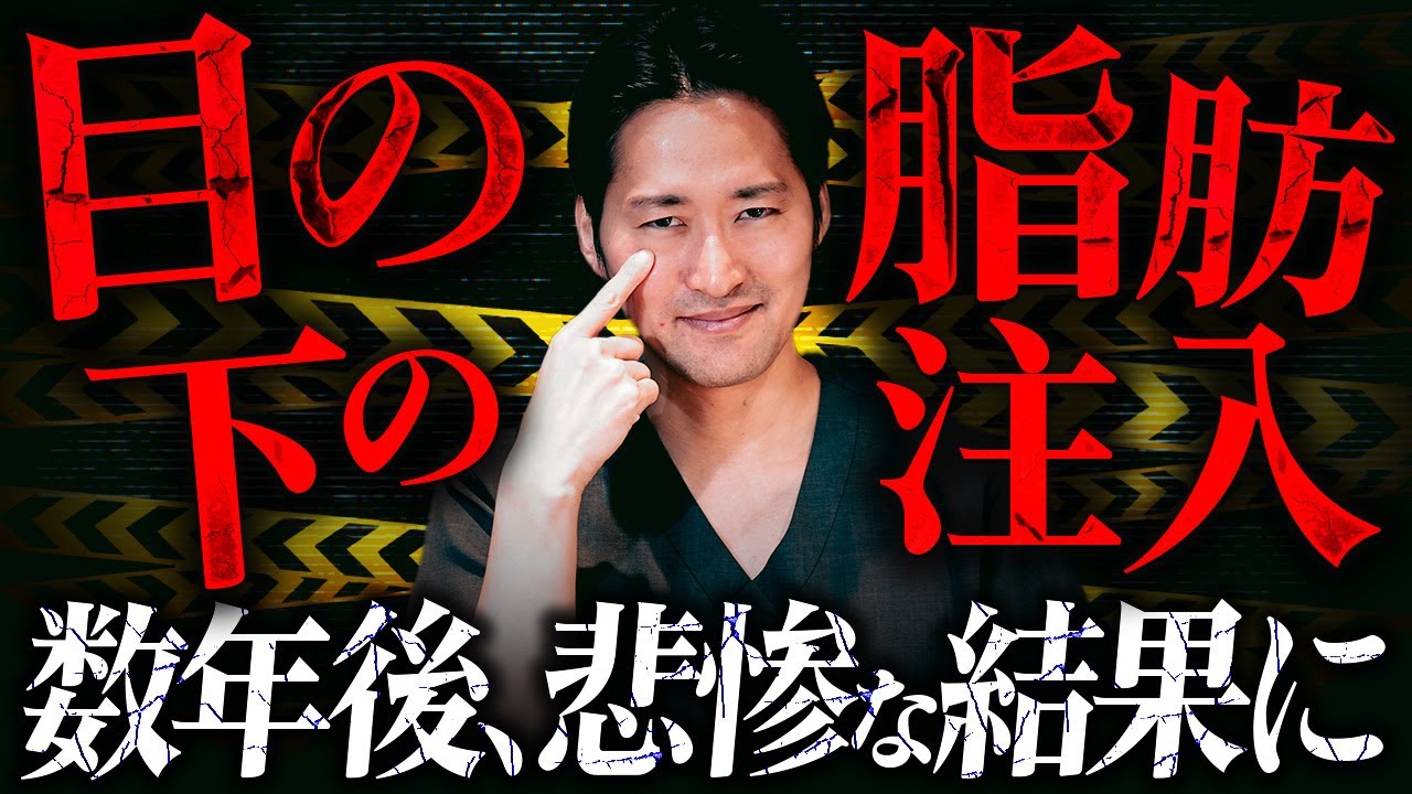 【警告】トラブル続出してます…目の下の脂肪注入はおすすめしません。【クマ治療】