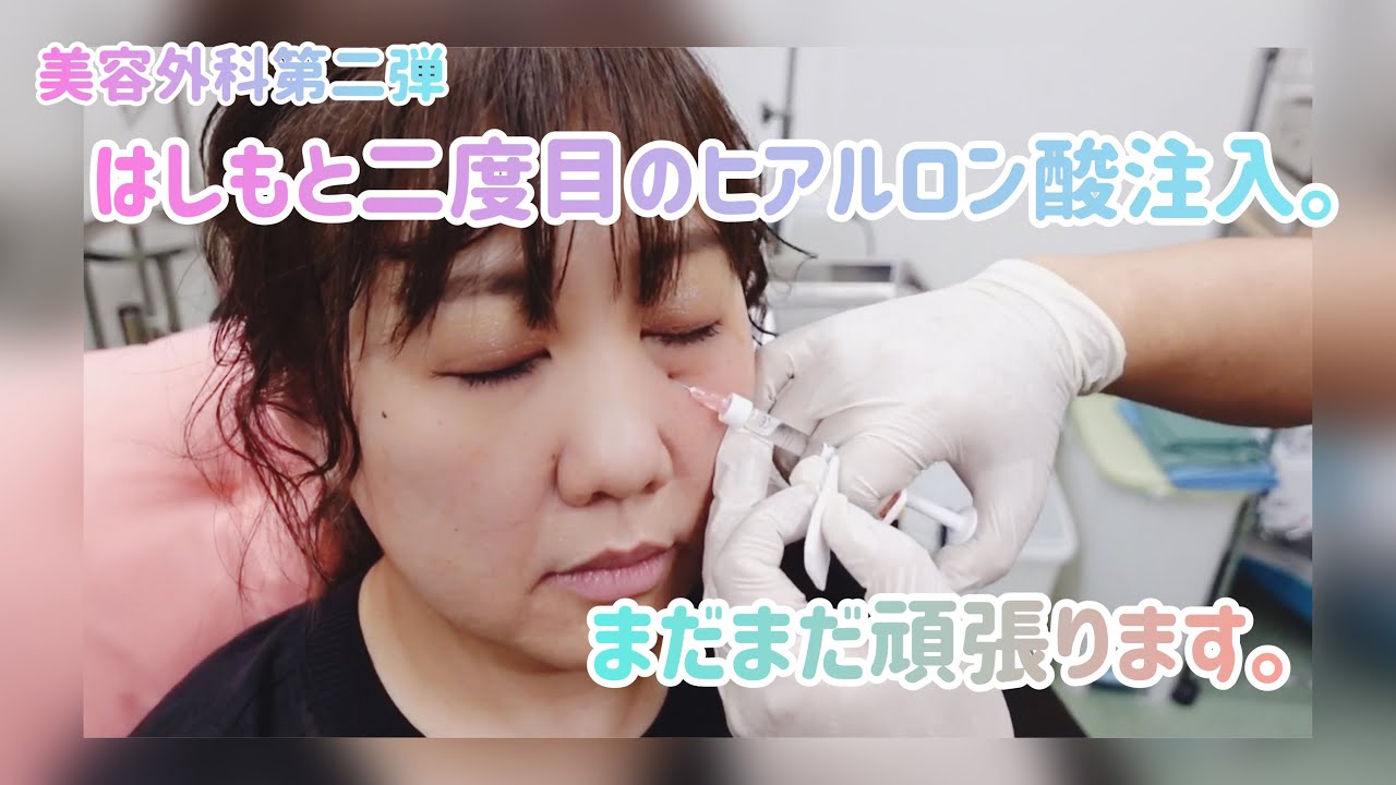 【二度目のヒアルロン酸注入❣️】