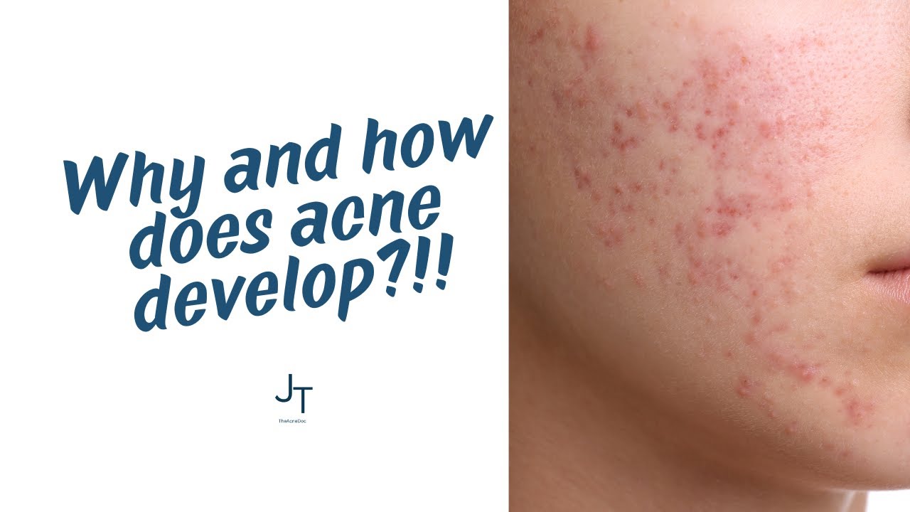 Acne Pathogenesis Explained: Hormones, Sebum, C. acnes & Inflammation