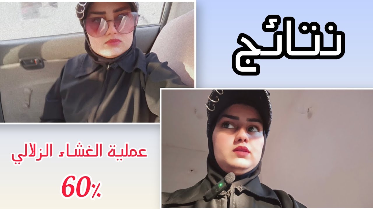#فلوگ نتائج عملية الغشاء الزلالي حول الركبه✨ كم نسبة ازاله الغشاء؟ وهل راح اتأثر مستقبلا؟ #احبكم❤
