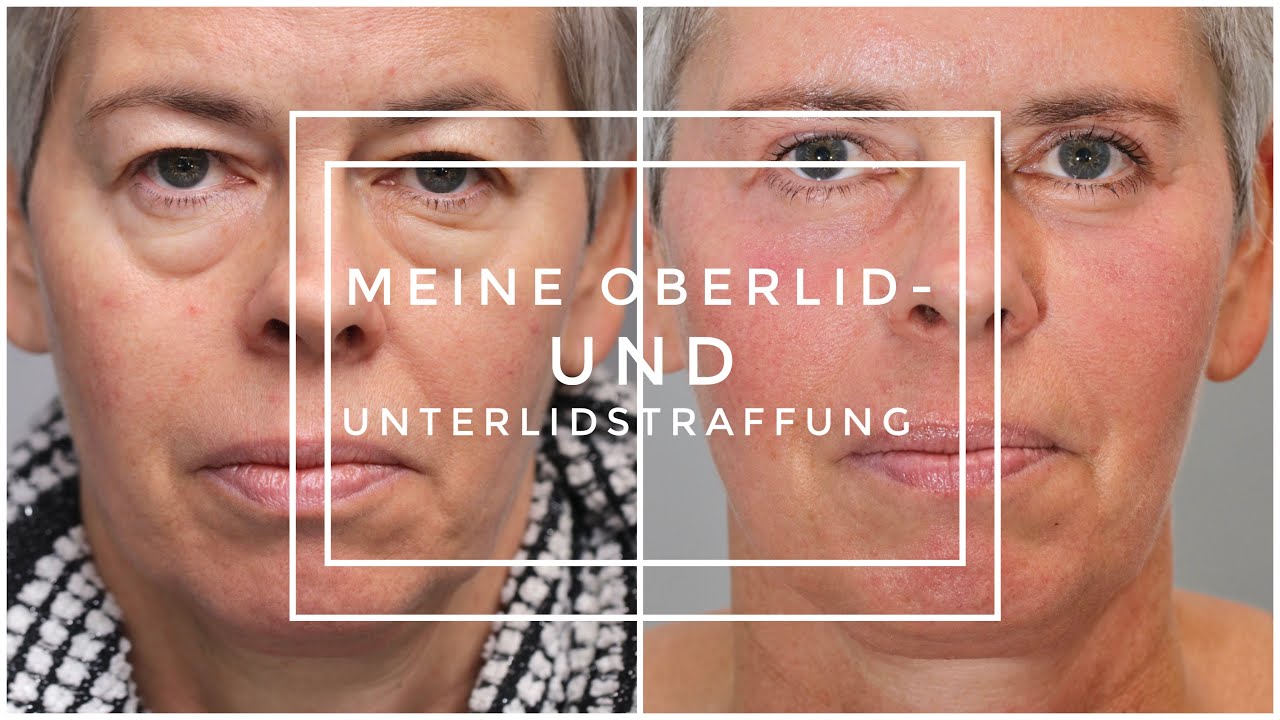 Oberlidstraffung und Unterlidstraffung. Vorher-Nachher. Dr. Aral in Köln - LIDMED