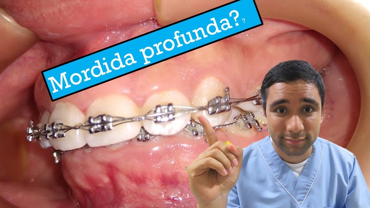 Arcos de curva inversa para mordida profunda en ortodoncia!! Cuales son??😎