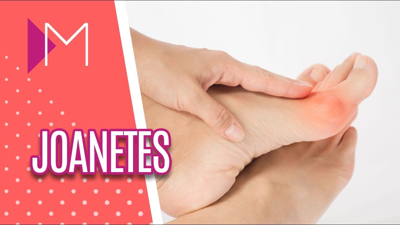 Joanetes: Causas, Sintomas e Tratamentos - Mulheres (01/06/18)