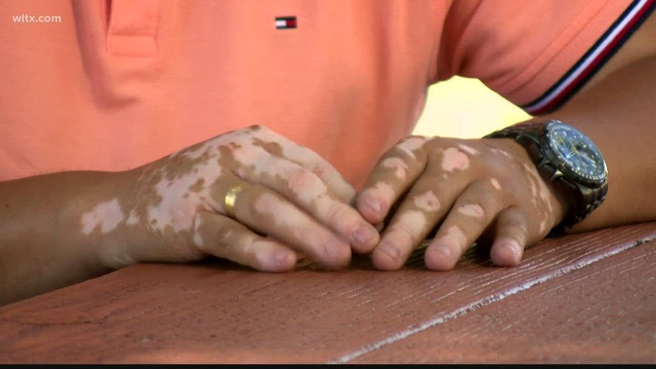 New FDA approved treatment for vitiligo