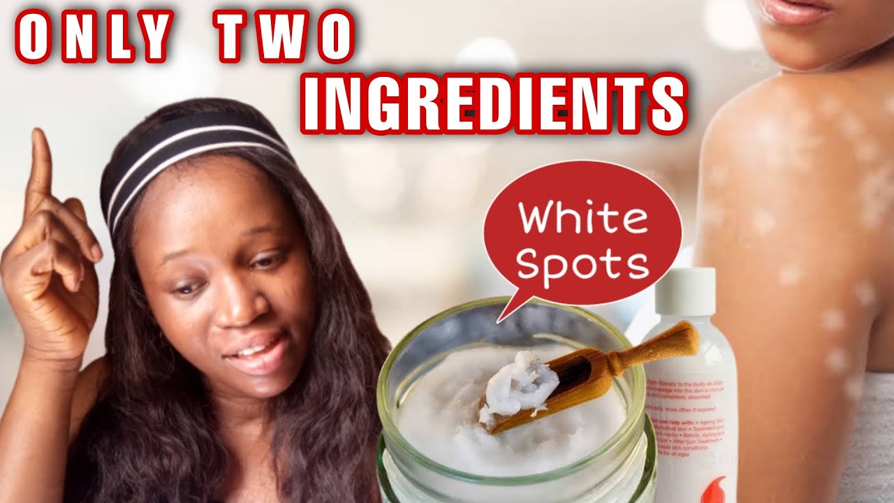 EFFECTIVE TREATMENT FOR WHITE PATCHES, WHITE SPOT, VITILIGO & UNEVEN SKIN COMPLEXION #whitepatches