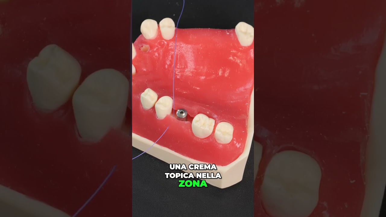 Impianto dentale: indolore e sicuro