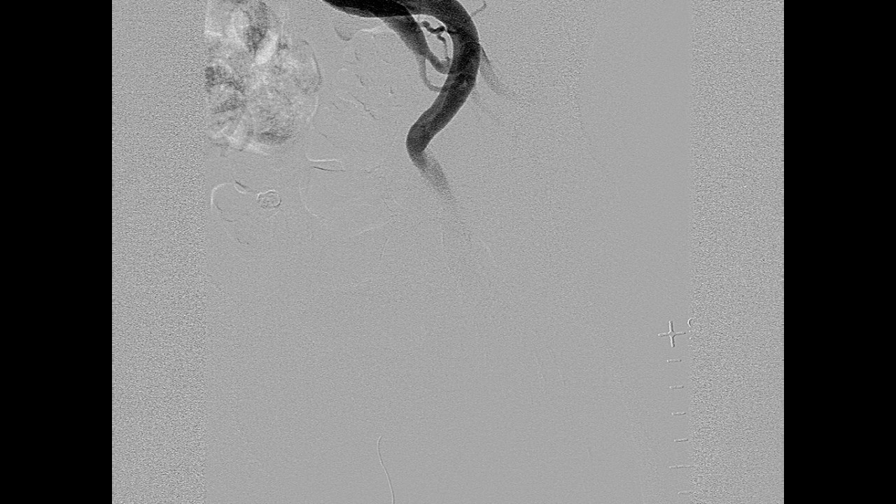 iliac angiogram