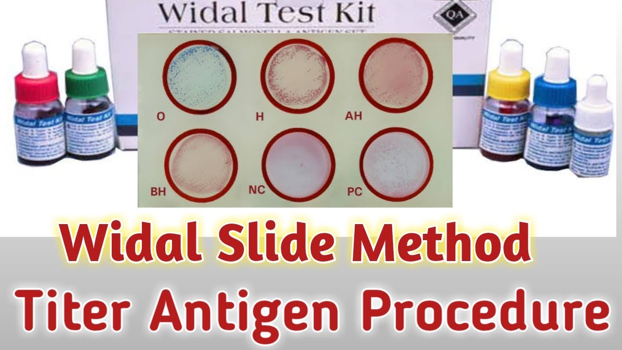 widal test | widal slide test in hindi | widal test slide method report | widal titer procedure