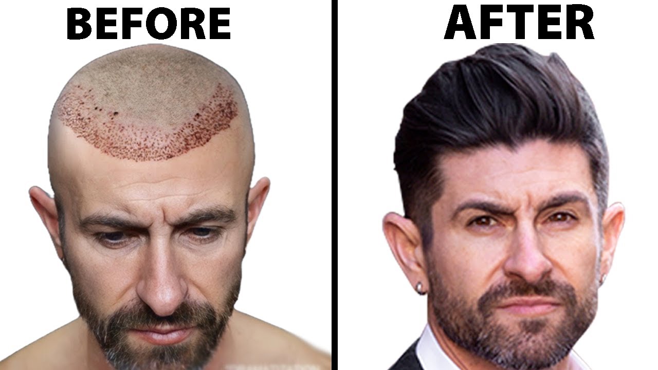 What's It Like To Get A Hair Transplant? | Hair Surgeon Reacts