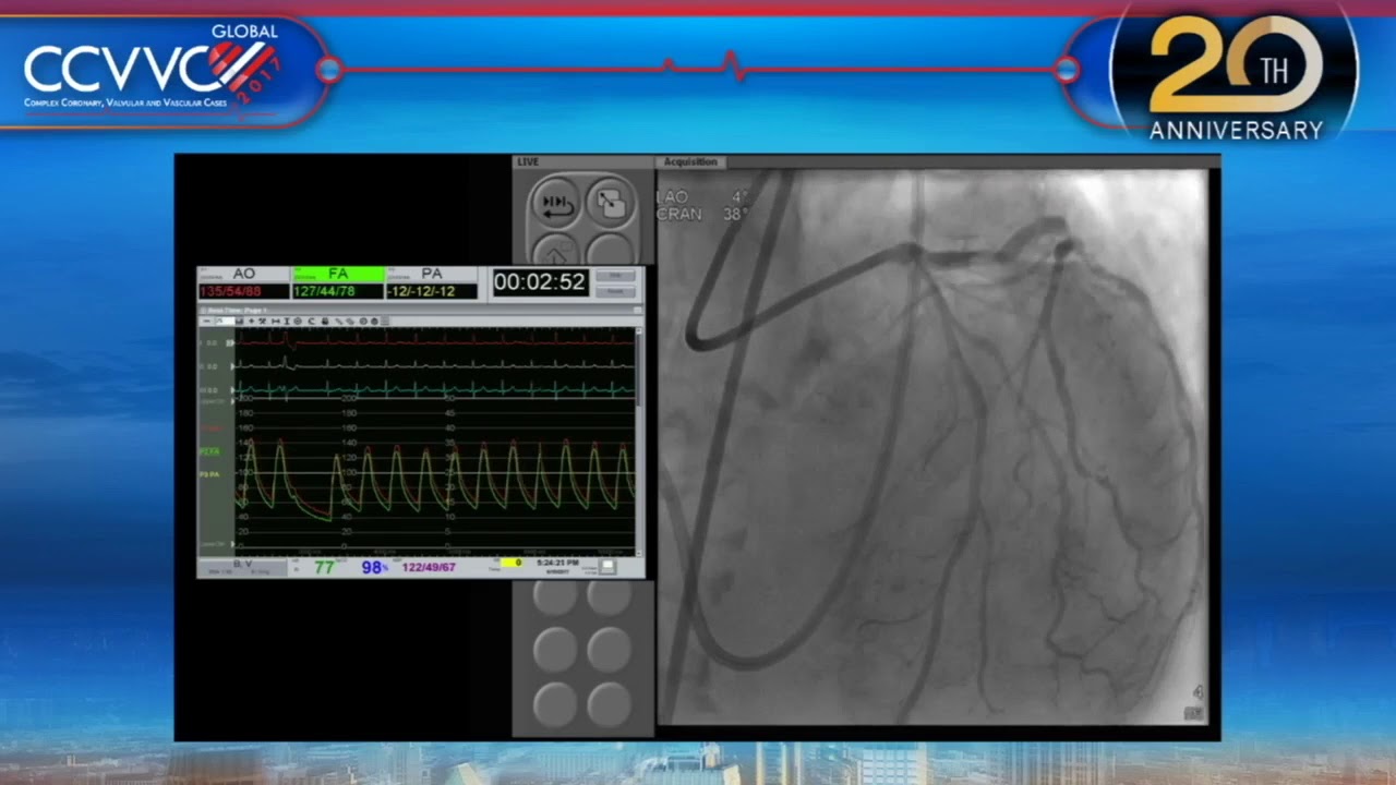 Live Case 13 - Complex High Risk Calcified LM LAD Intervention with BAV - CCVVC 2017