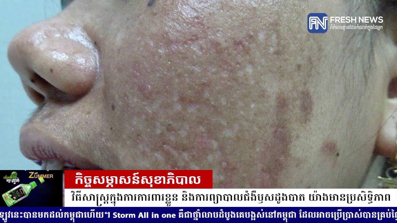 លោកវេជ្ជបណ្ឌិត តូច យ៉ាន ជំនាញព្យាបាលជំងឺឬសដូងបាត បកស្រាយលម្អិត ...