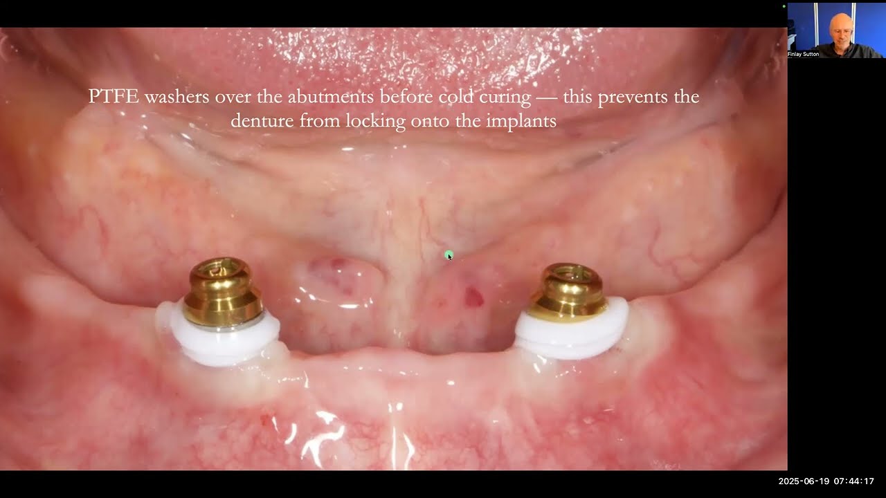 Paul’s Case: Chairside Locator Fitting & Milling-in Paste for Perfect Denture Bite – Study Club Live