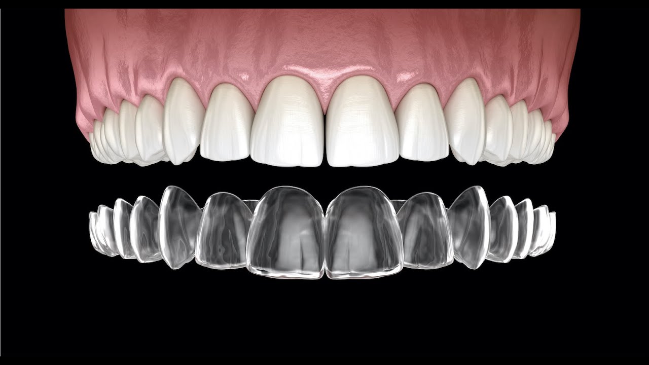 Invisalign: раскрытие скрытых рисков 