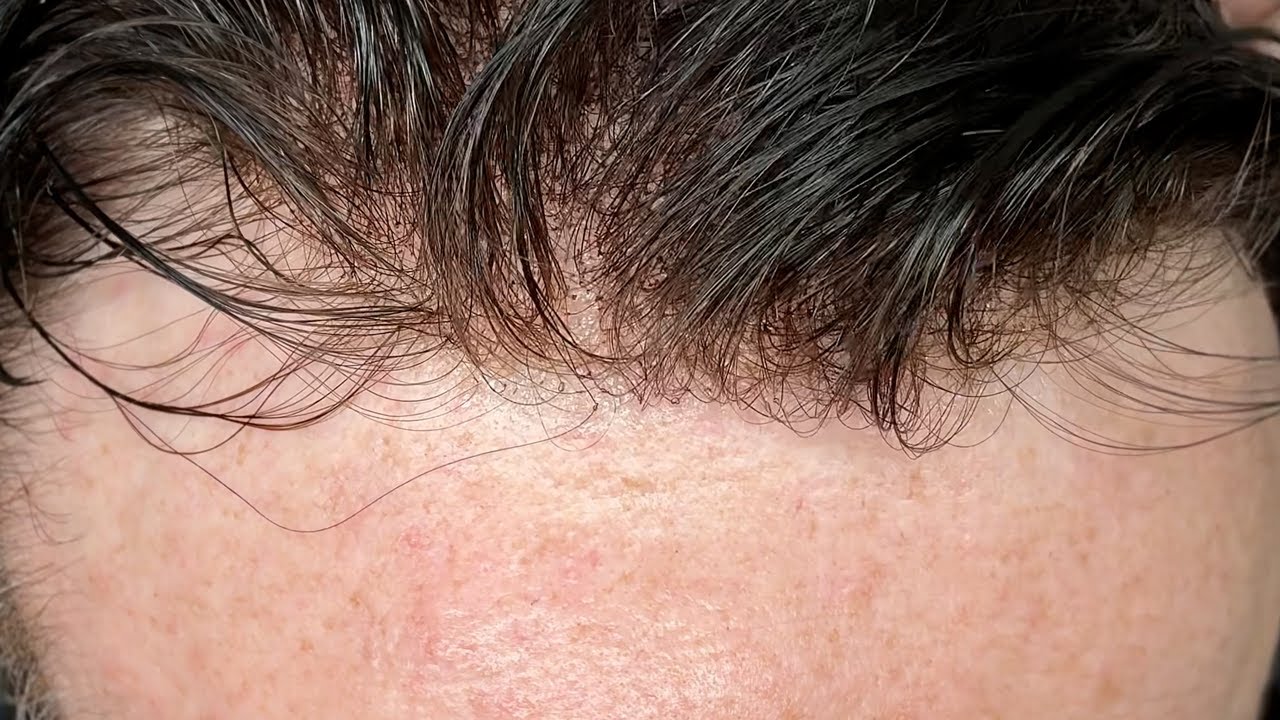 Super Fine Swiss Lace 'Air' Hair System. A Comprehensive Review.