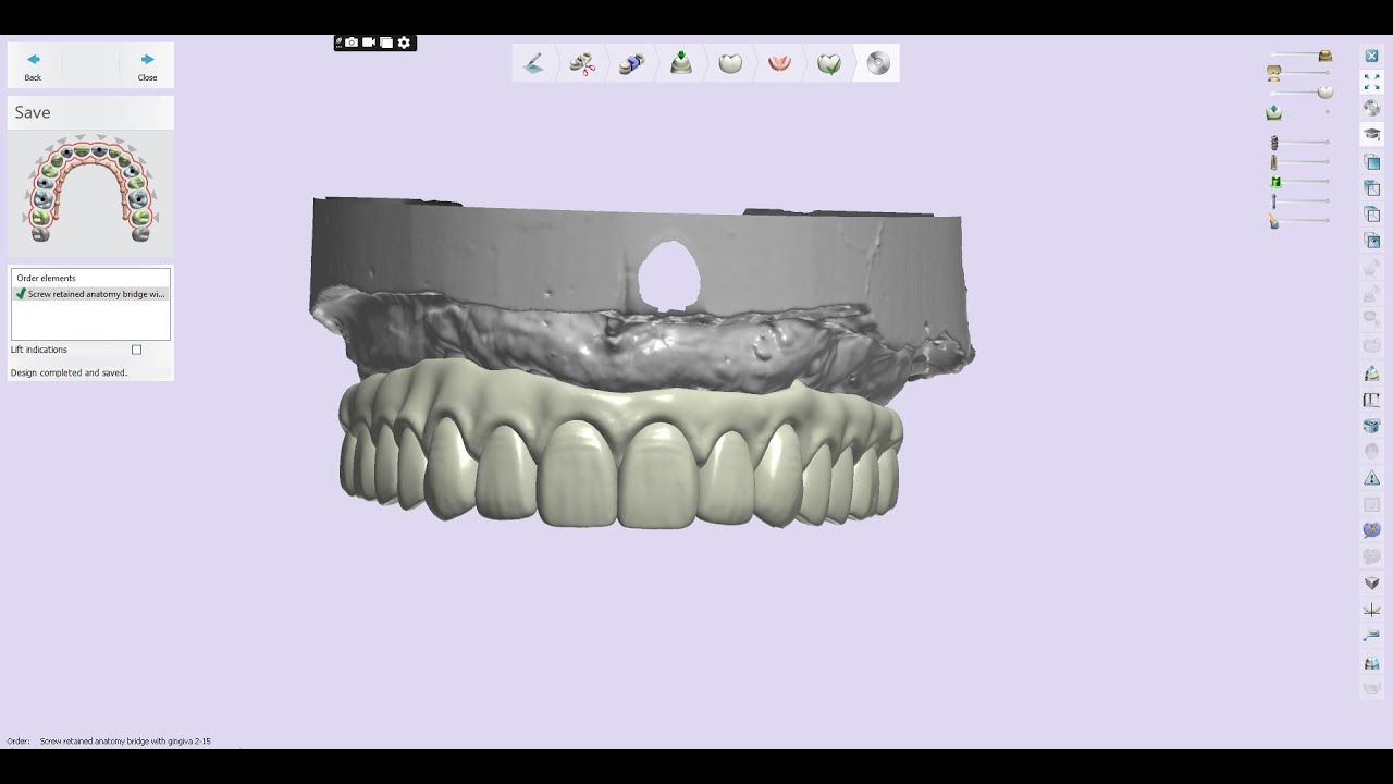 3Shape All on 6 Screw Retained Bridge with Gingiva 033023