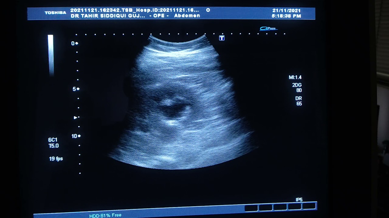 DUPLEX RENAL COLLECTING SYSTEM with BIFID URETERS