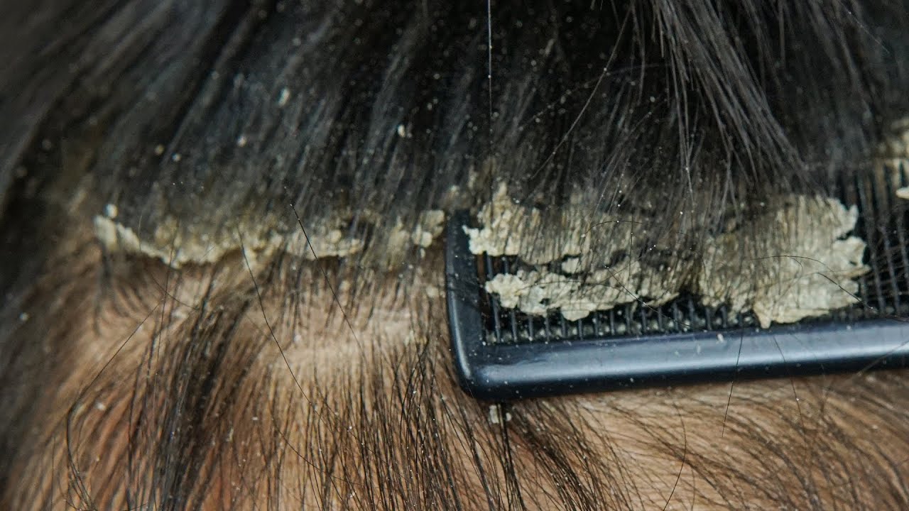 ASMR Satisfying Scalp Care: Cleaning Dandruff with Comb and Brush #40