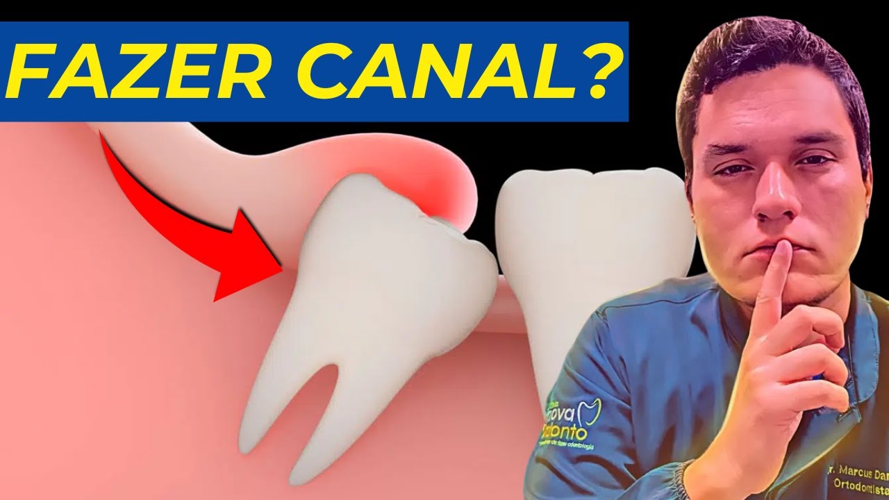 D&aacute; para TRATAR CANAL em DENTE DO SISO? (A verdade).