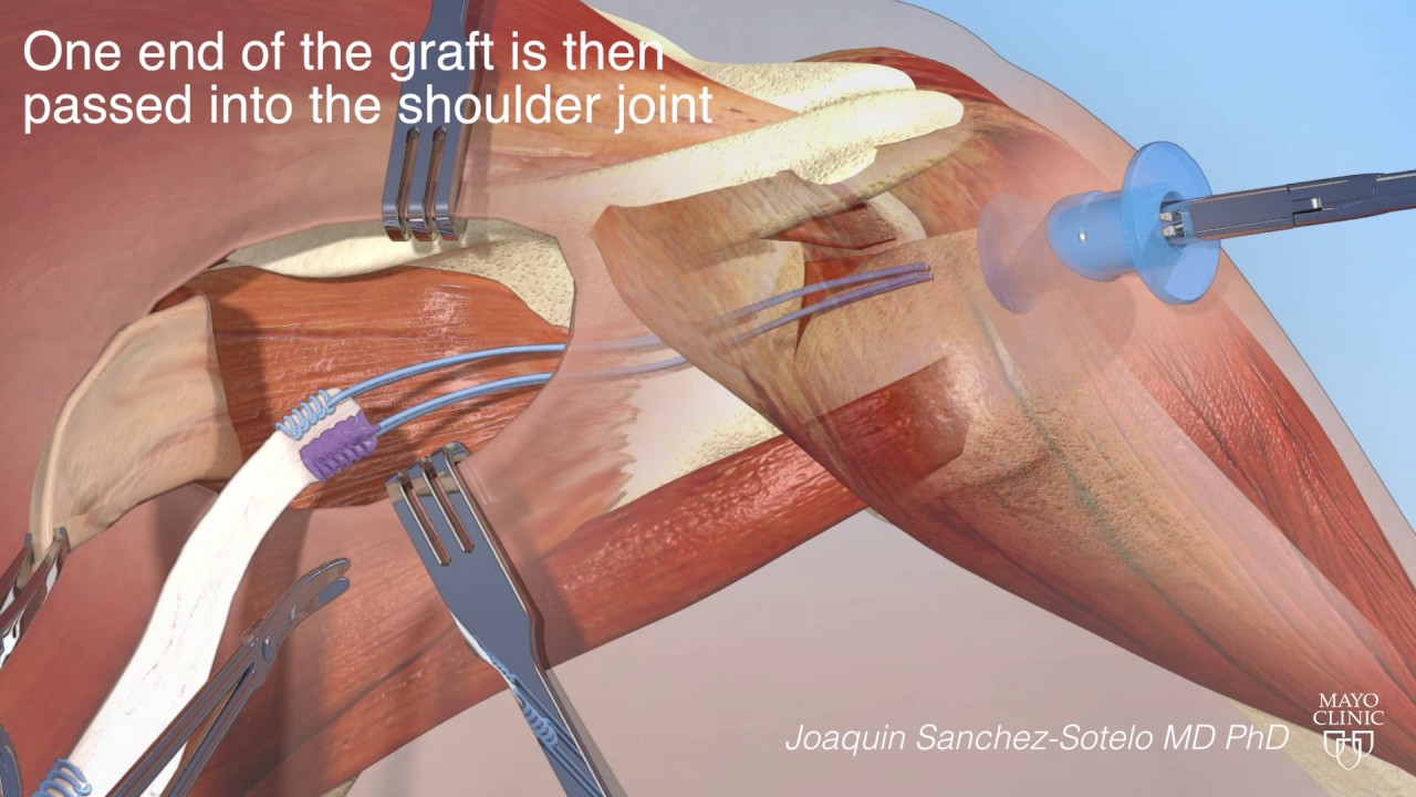 Arthroscopically assisted lower trapezius transfer for irreparable rotator cuff tears