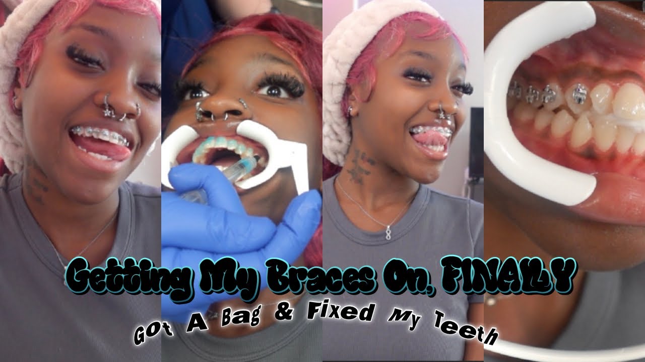 Getting Braces for the First Time 😭 | Come With Me to the Ortho! | Beauteous Benita