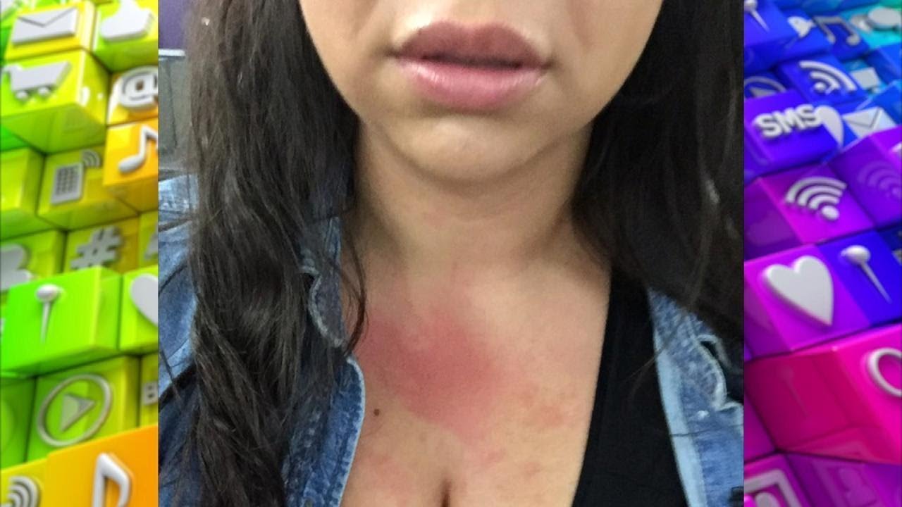 Could Your Skin Rash Be Caused by Stress?