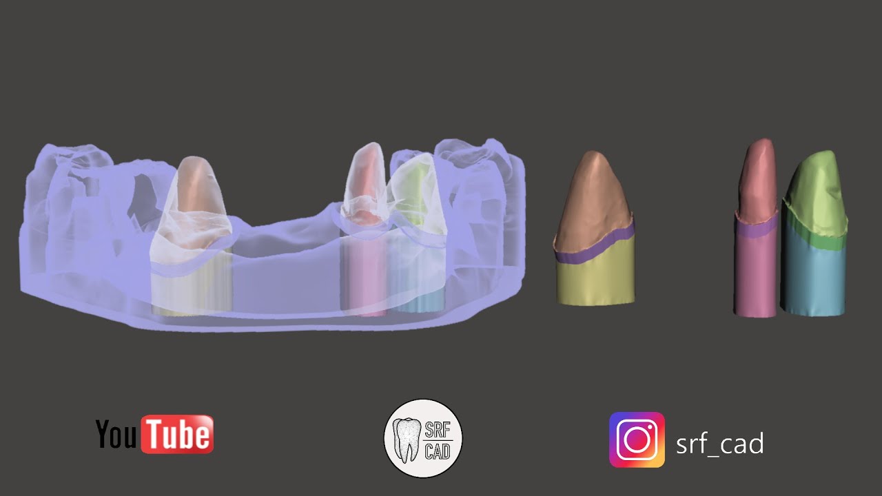 MESHMIXER DENTAL COME RICAVARE UN MONCONE DA UN DITCHING SU MODELLO DA IMPRONTA INTRAORALE  DIE PIN