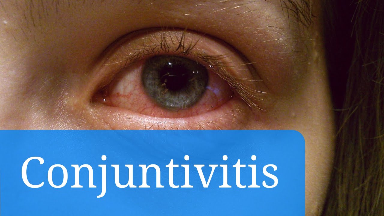 Conjuntivitis vírica, alérgica y bacteriana: síntomas y tratamiento