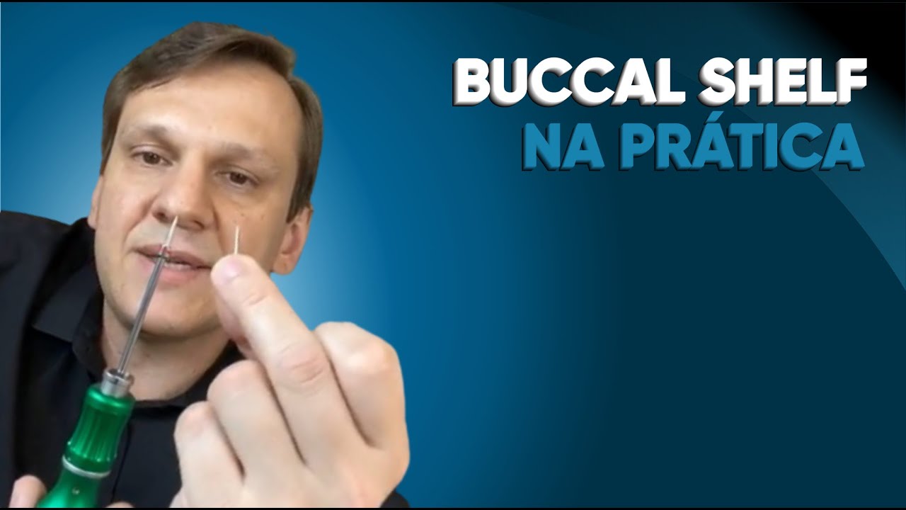 BUCCAL SHELF NA PRÁTICA I HANDS ON I PROF. RODRIGO MILANI