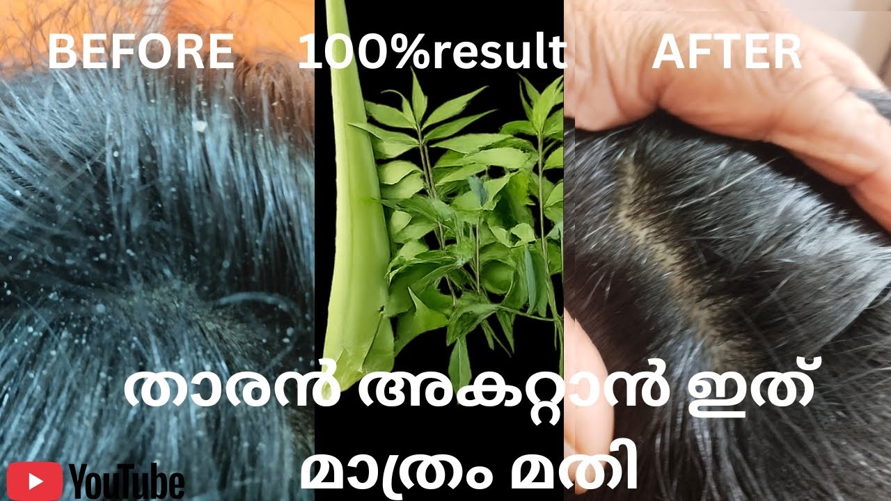 Dandruff നു വിട 😃100%Result 🌿