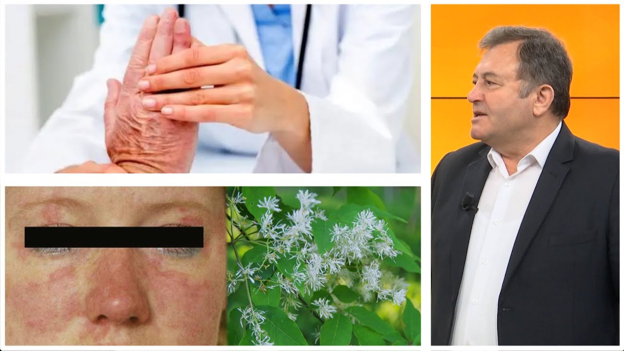Shenjat në lëkurë që paralajmërojnë sëmundjen e rëndë / Ylli Merja jep këshilla trajtimi