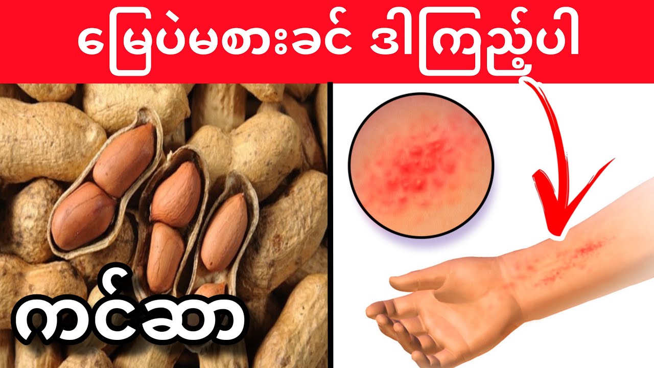 မြေပဲမစားခင် သိကိုသိထားရမယ့်ဆောင်ရန်ရှောင်ရန် (၄) ချက် (ကင်ဆာ? မြေပဲပြုတ်/ လှော်?)