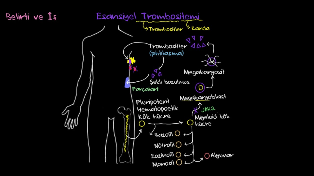 Esansiyel Trombositemi Nedir? (Sağlık Bilgisi ve Tıp)