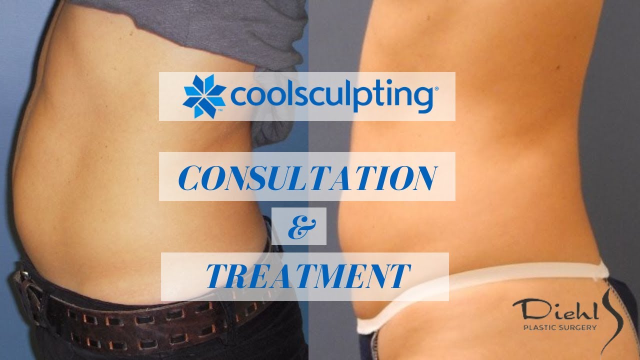 CoolSculpting Consultation and Treatment