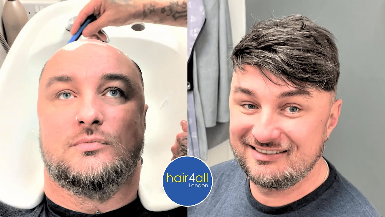 Before & After | Hair System | Non-Surgical Hair Replacement System Men/Women | UK/USA/International