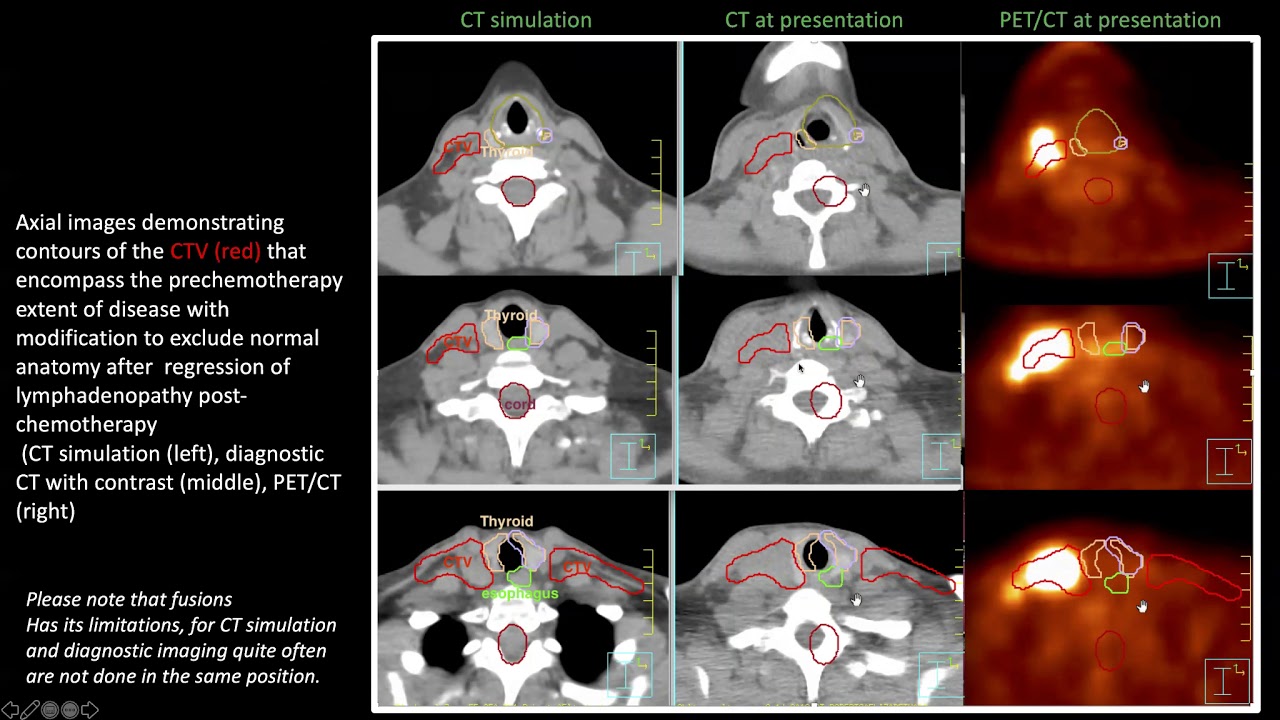 Dr. Bouthaina Dabaja: Radiation Therapy for Lymphoma of the Mediastinum