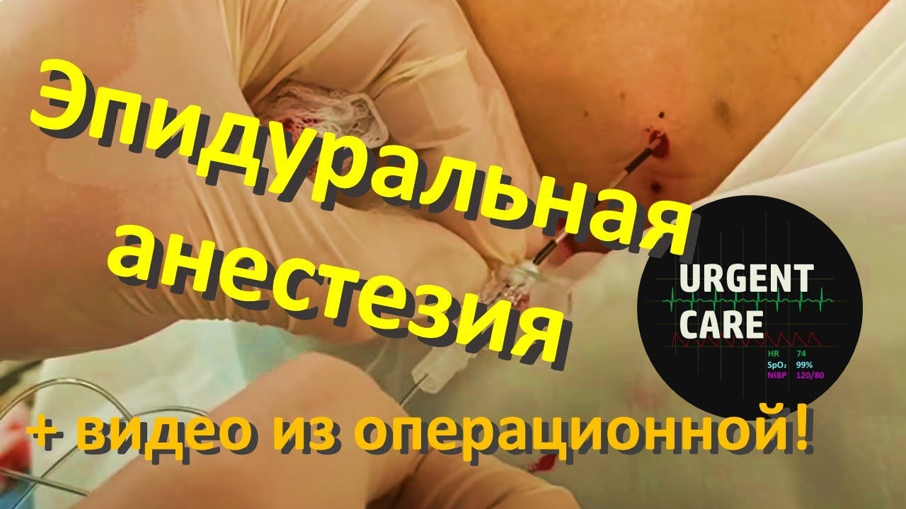 Эпидуральная анестезия. Лекция + видео из операционной!