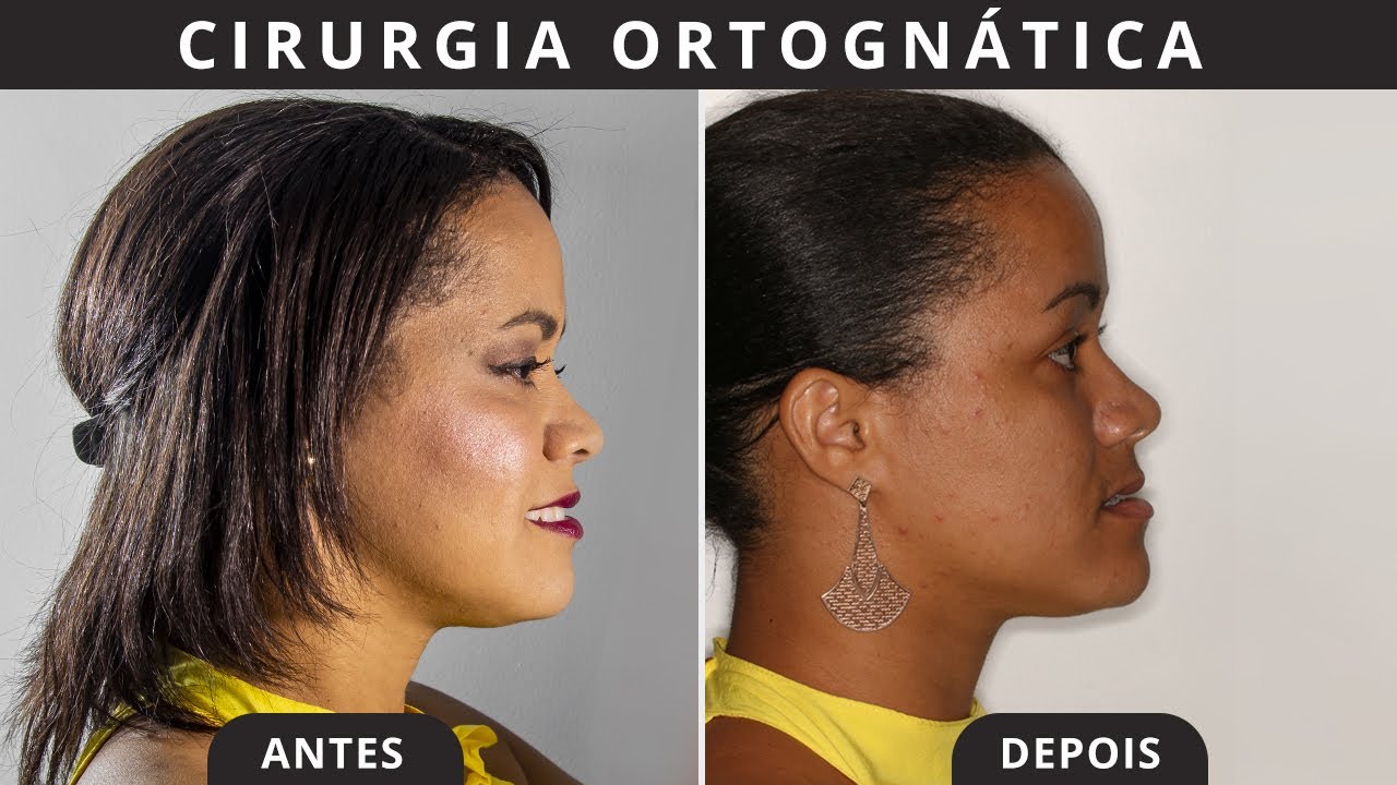 Cirurgia Ortognática: Ana Clélia.
