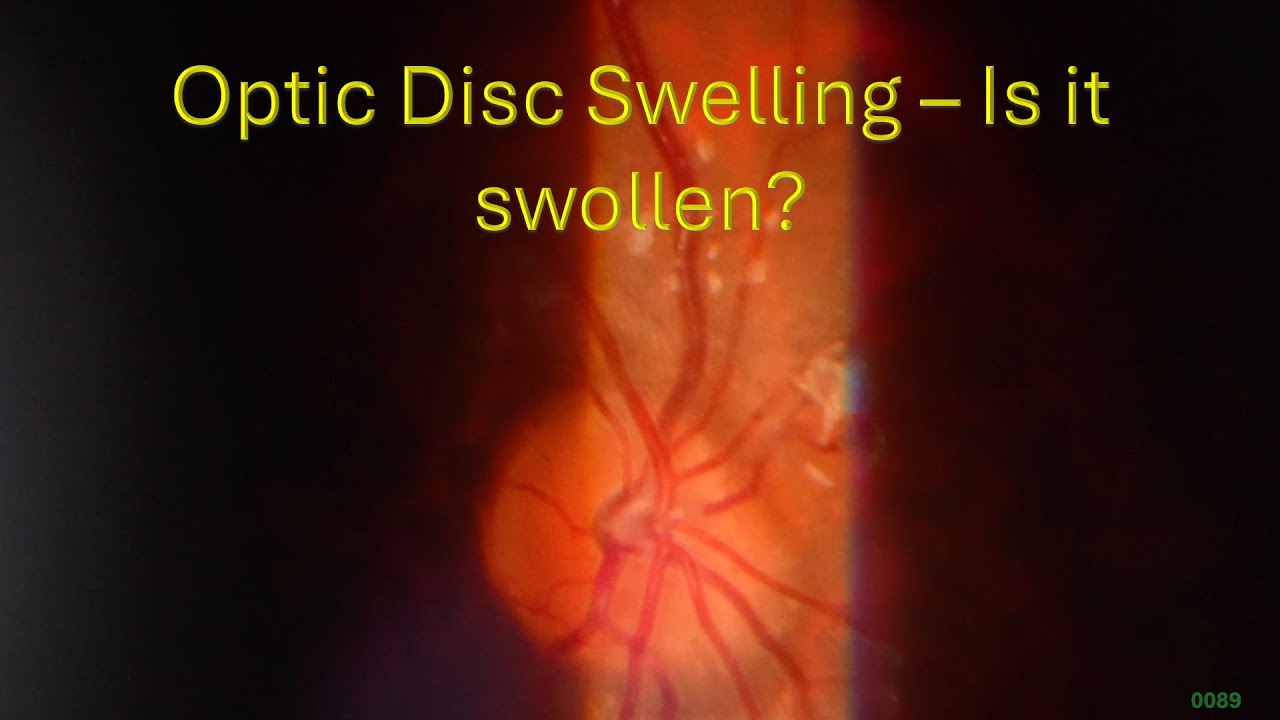0089: Optic Disc Swelling - Is it Swollen?
