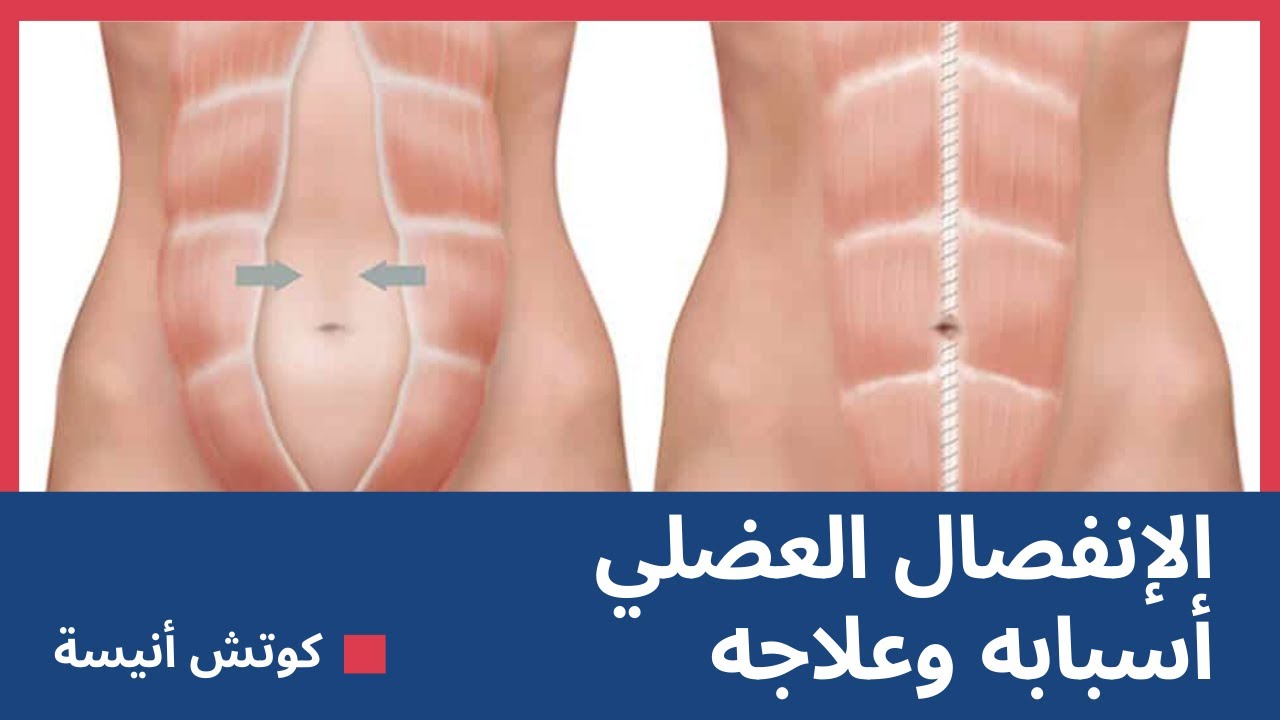 الانفصال العضلي أسبابه و علاجه👌كوتش أنيسة