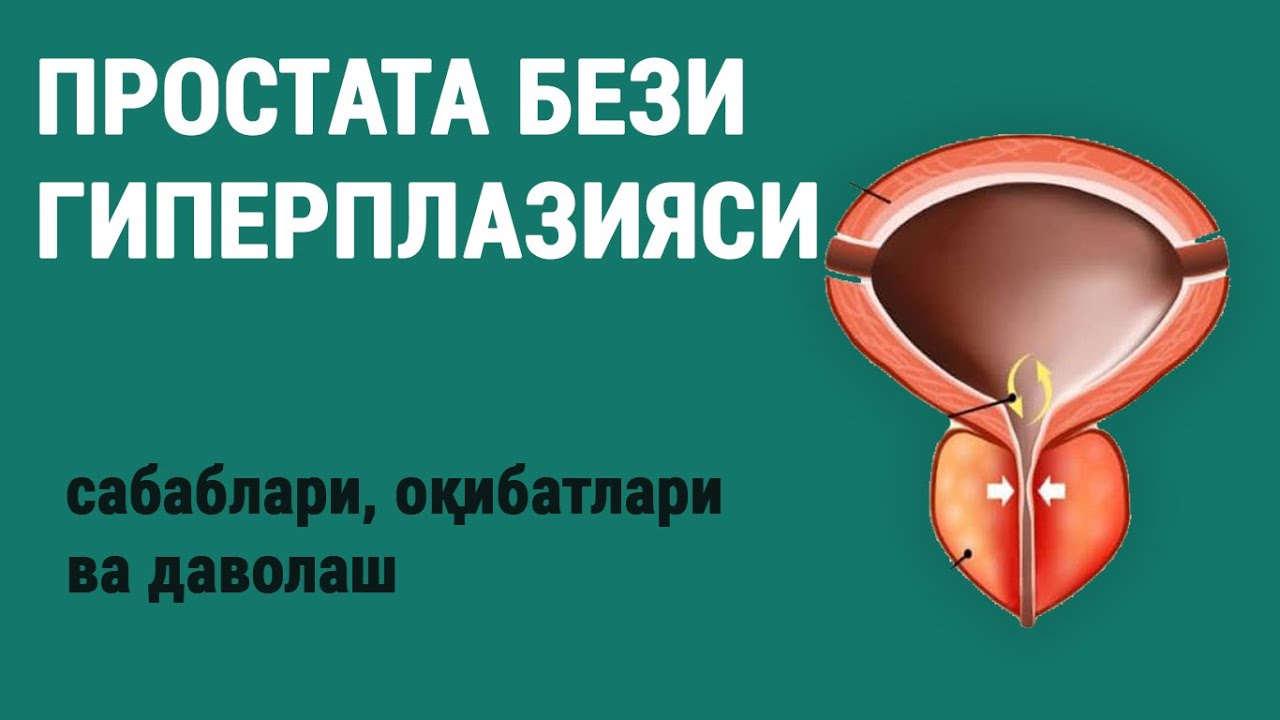 Простата бези гиперплазияси | Простата аденомаси. Сабаблари, оқибатлари ва даволаш.