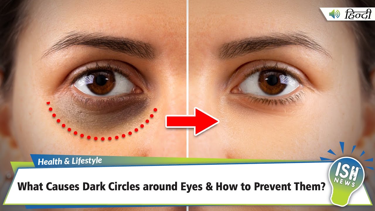 What Causes Dark Circles around Eyes & How to Prevent Them? | ISH News