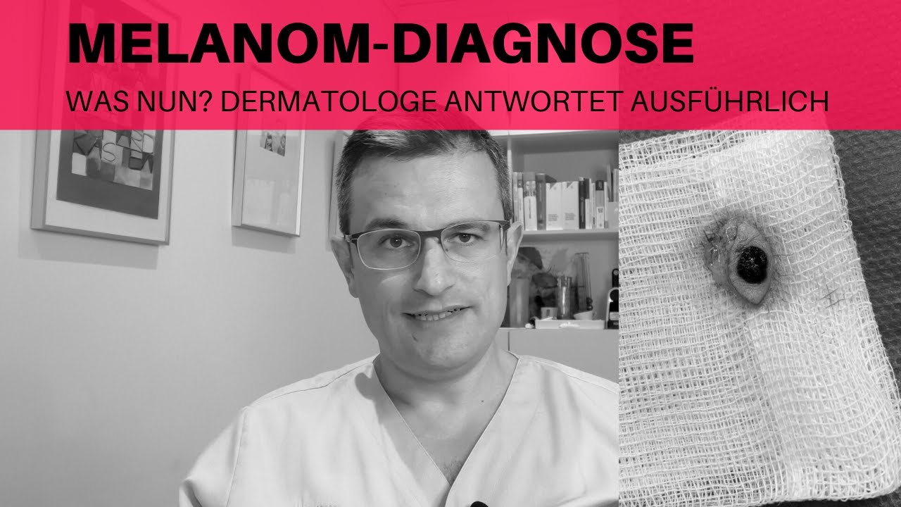 MELANOM Diagnose (SCHWARZER HAUTKREBS): WAS NUN? Ausführliche Informationen vom Dermatologen