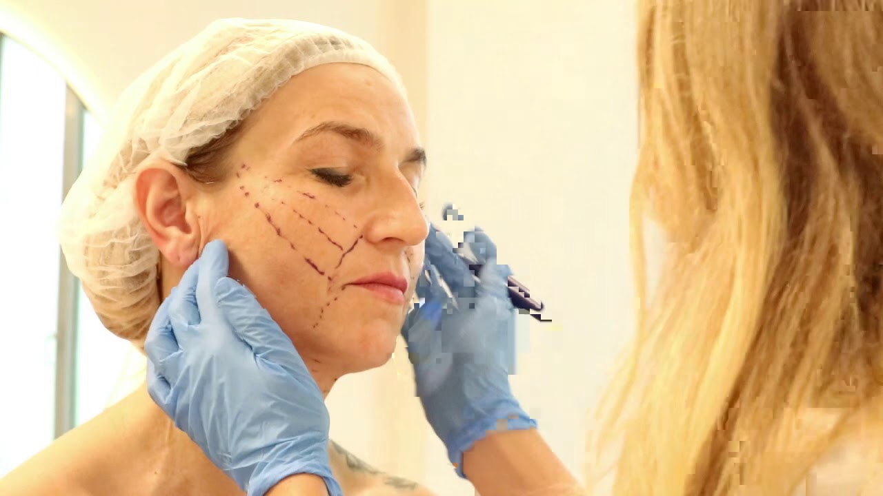Lifting nićmi Aptos - dr Elżbieta Techmańska, Klinika Dr Dębski